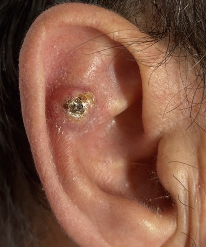 Oreille avec infection visible et lésion cutanée.