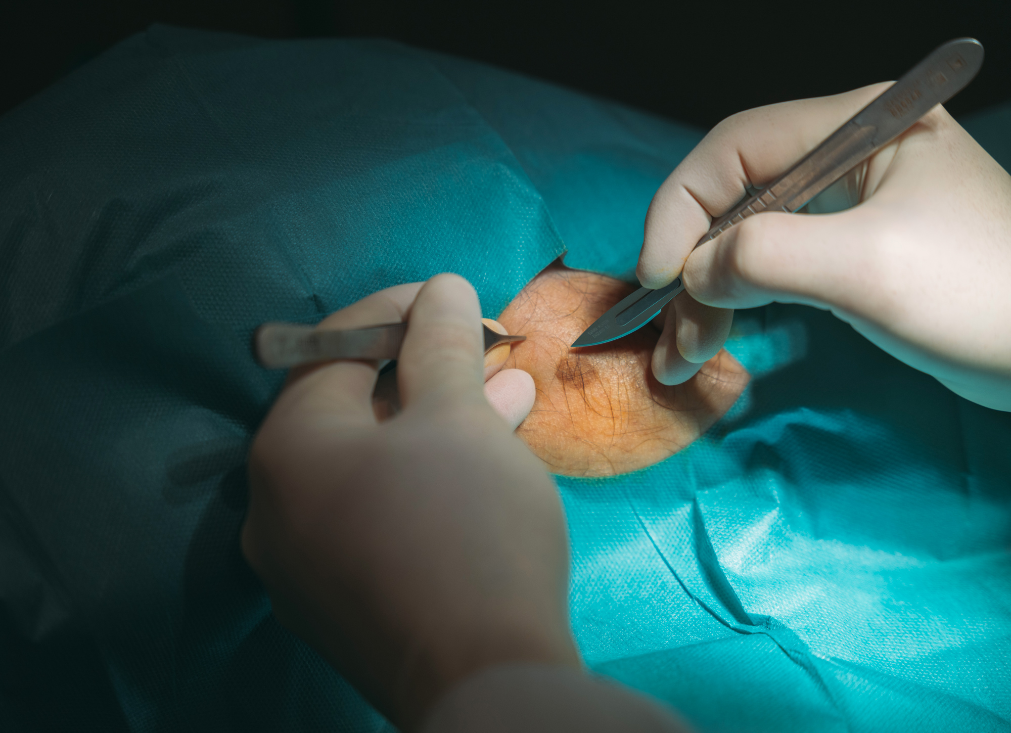 Chirurgie de la main en salle d'opération
